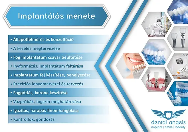 Fogimplantátumok - dentalangels.hu