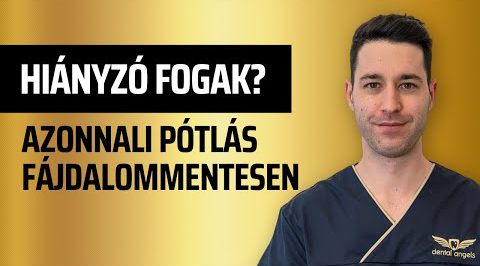 Fogpótlás egy fogtömés ideje alatt, fájdalommentesen? Implantálás akár azonnal! - video - dentalangels.hu