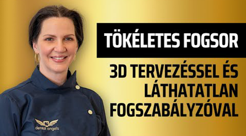 Tökéletes fogsor 3D tervezéssel? Invisalign a láthatatlan megoldás! - video - dentalangels.hu