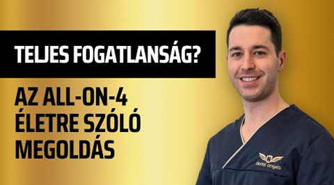 Azonnali megoldás akár teljes fogatlanságra? All-on-4 az azonnali implantáció! - video - dentalangels.hu