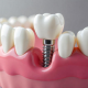 Fogimplantatum lepesrol lepesre – minden, amit tudni szeretnel - dentalangels.hu