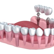 Amikor az ember visszakap valamit, amit már elengedett – Gergely és a fogimplantátum - dentalangels.hu