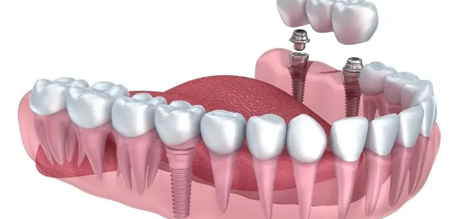 Amikor az ember visszakap valamit, amit már elengedett – Gergely és a fogimplantátum - dentalangels.hu