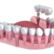Amikor az ember visszakap valamit, amit már elengedett – Gergely és a fogimplantátum - dentalangels.hu