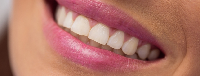 Direkt héj vagy porcelán héj – melyik a jobb választás - dentalangels.hu