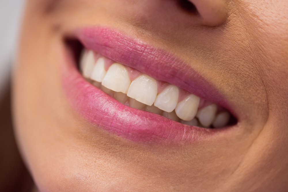 Direkt héj vagy porcelán héj – melyik a jobb választás - dentalangels.hu
