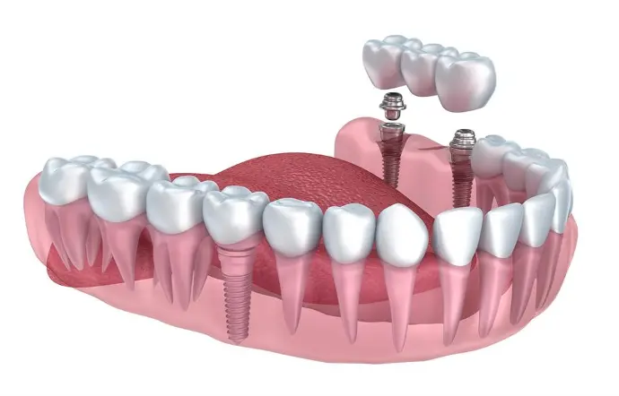 Fogimplantátum sportolóknak – stabil megoldás aktív életmódhoz - dentalangels.hu
